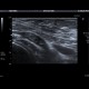 Trombembolus of axillary artery: US - Ultrasound